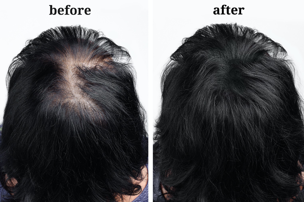 Female Alopecia and Hair Loss Treatments