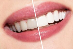 GET A WHITER SMILE IN THE TORONTO GTA AT ADVANCED WHITE TEETH WHITENING CLINIC