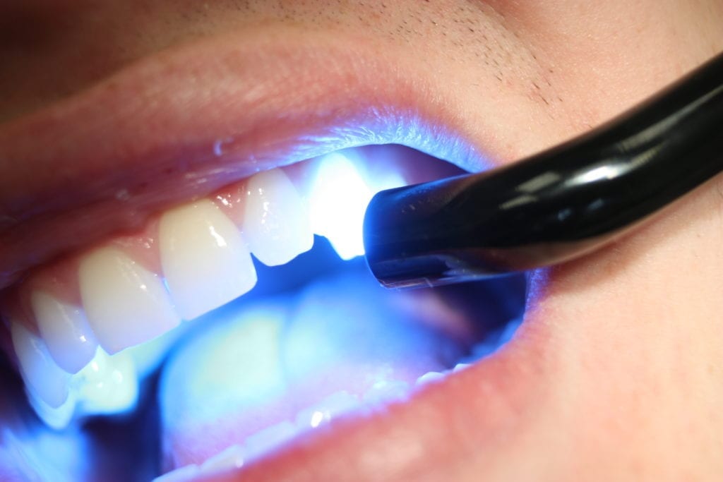 Teeth Whitening Toronto