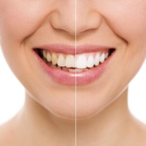 Toronto Laser Teeth Whitening: A Comprehensive Guide