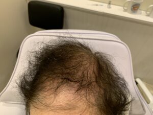 causes of alopecia Toronto