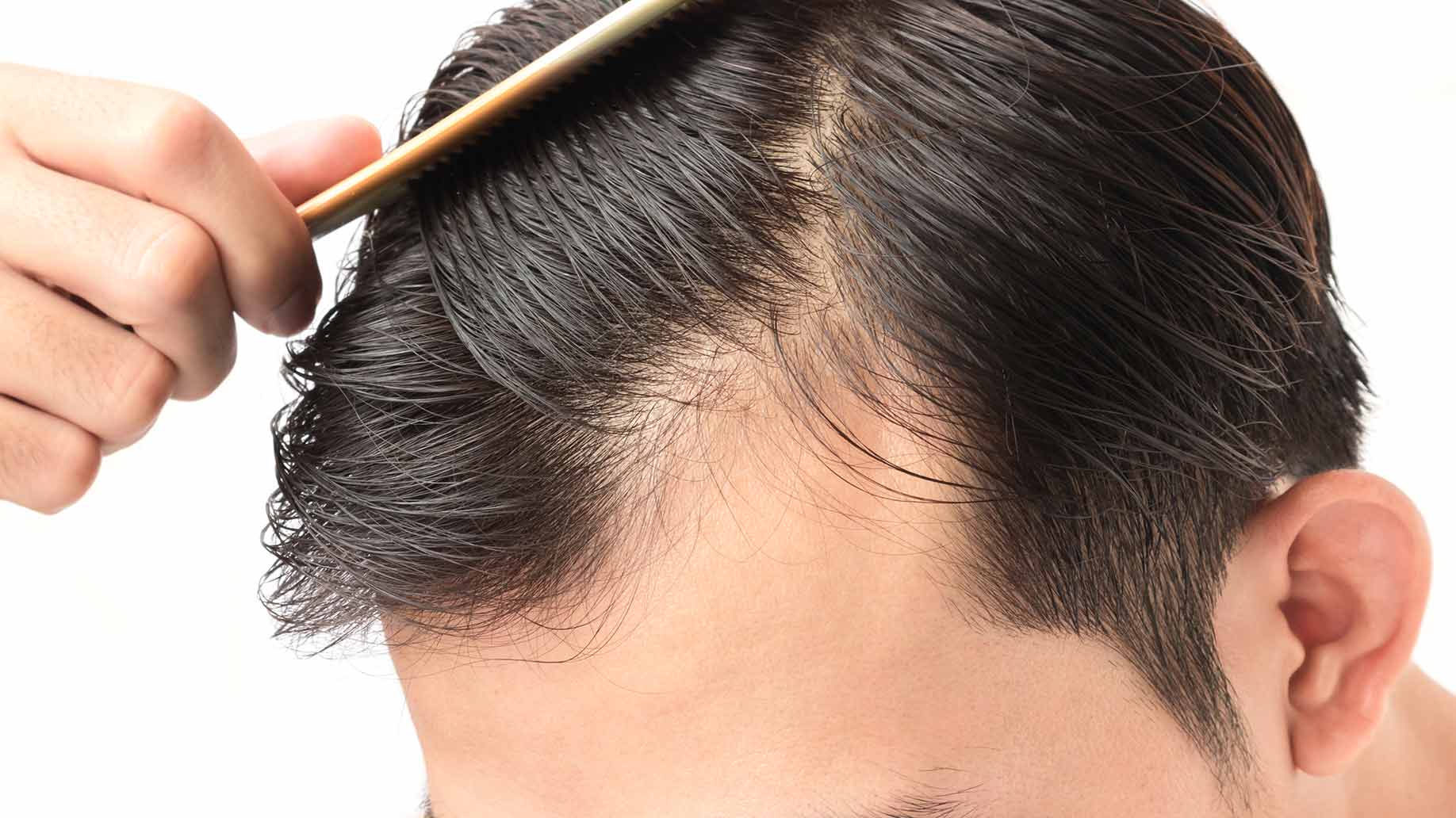 hair loss remedies Toronto