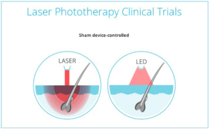 laser therapy for hair loss Toronto ON