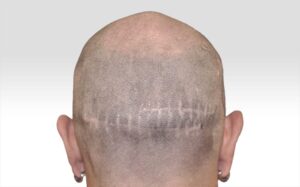 scalp micropigmentation vs hair transplant Toronto