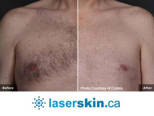 laser hair removal before and after
