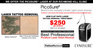 pico laser tattoo removal