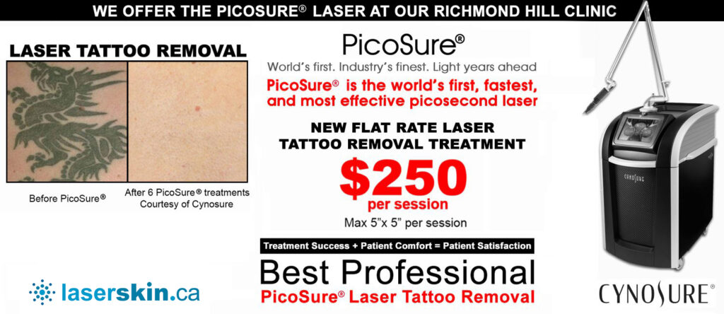 tattoo pain chart - laser tattoo removal Toronto