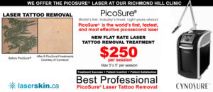tattoo sleeves - tattoo sleeve removal Toronto