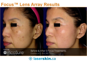 Focus-Lens-Array-Results-with-PicoSure-Laser-2