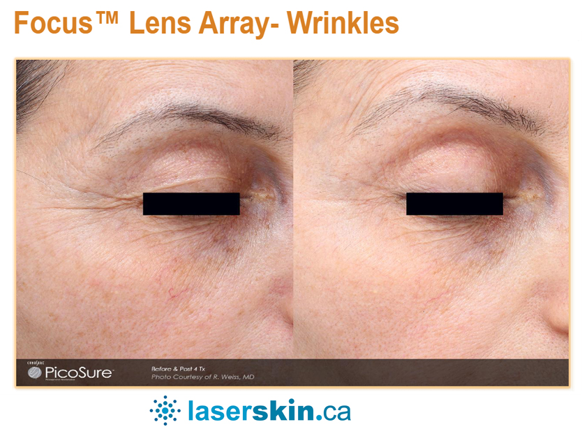 Focus Lens Array Results with PicoSure Laser Wrinkles