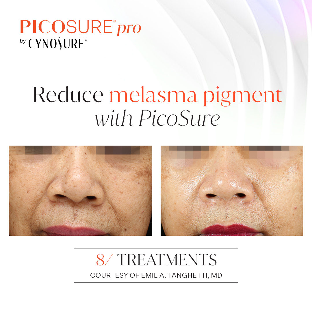 Picosure Laser Skin Rejuvenation Treatment Melasma