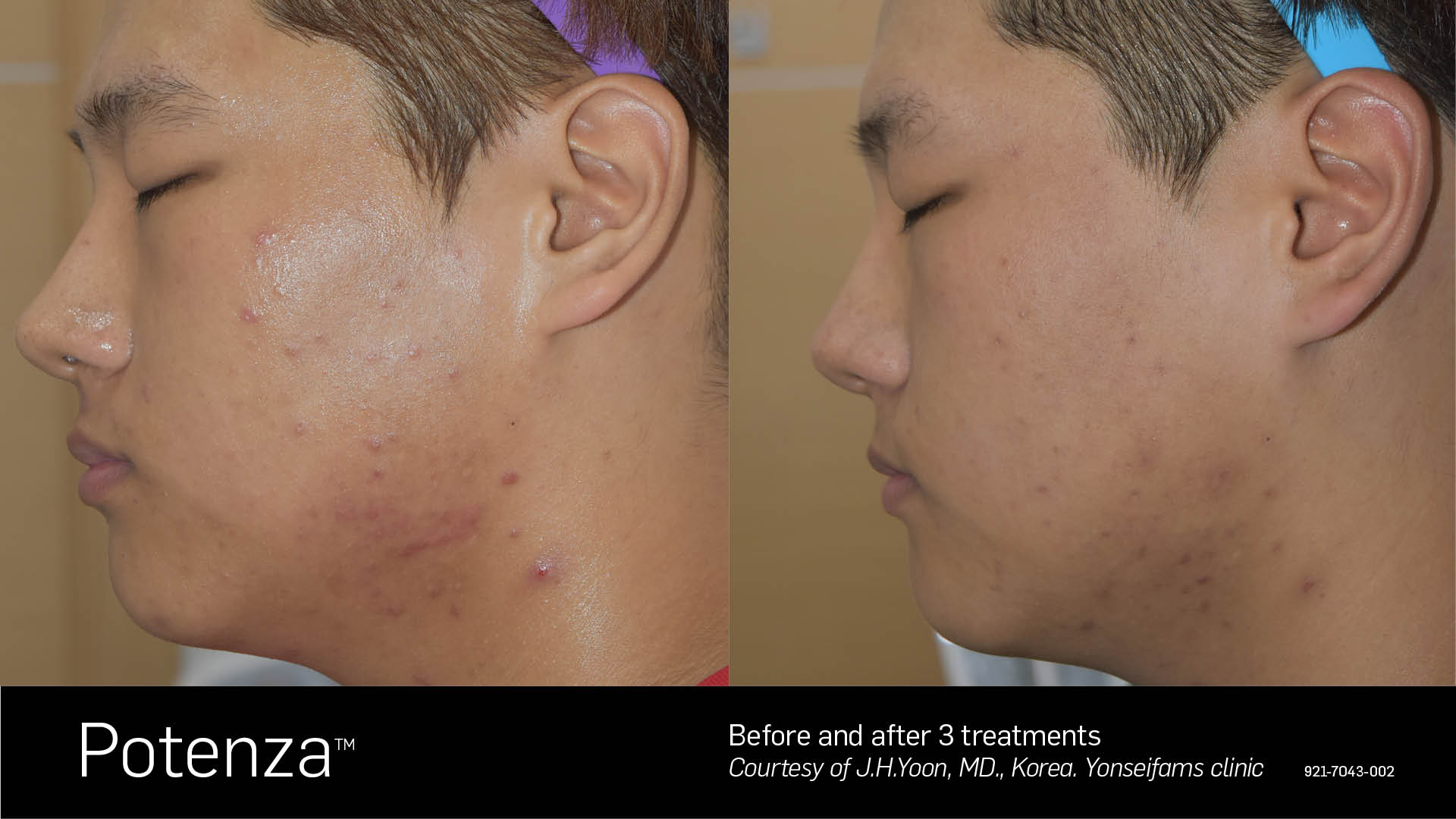 Potenza RF Microneedling Before and After 2