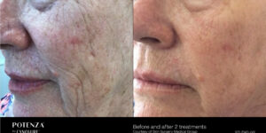 RF Microneedling Before and After Toronto Potenza