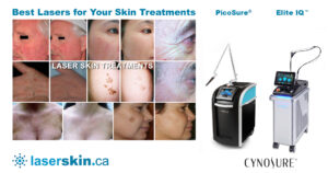 Skin rejuvenation skin tightening Toronto