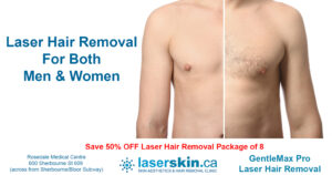 laser hair removal Toronto (1)