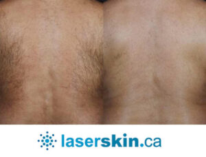 laser hair removal Toronto ON