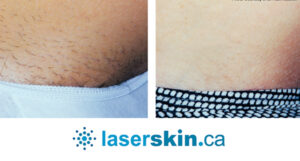 laser hair removal near me Pickering