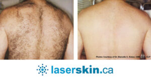 laser hair removal near me Toronto
