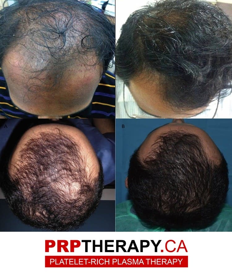 PRP hair treatment Toronto