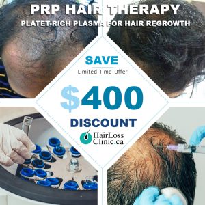 prp hair loss treatment