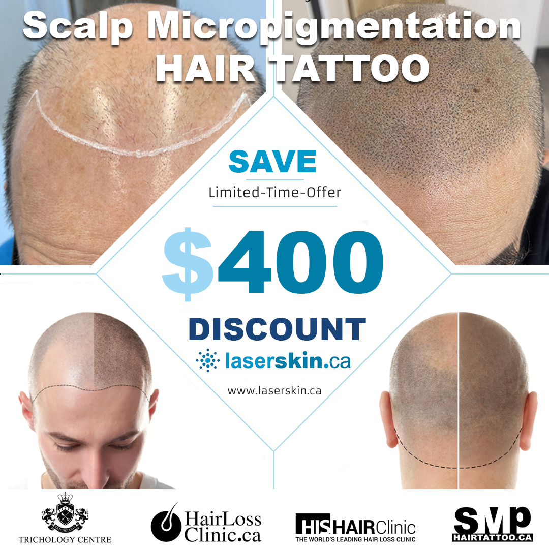 scalp-micropigmentation-Toronto-hair-tattoo