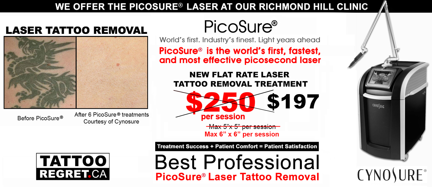 pico-laser-tattoo-removal-picosure-laser-Toronto