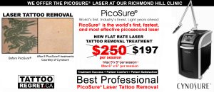 tattoo removal toronto - toronto tattoo removal - Picosure laser tattoo removal