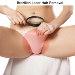 Brazilian laser hair removal Toronto