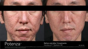 Potenza RF Micro needling before and after Toronto